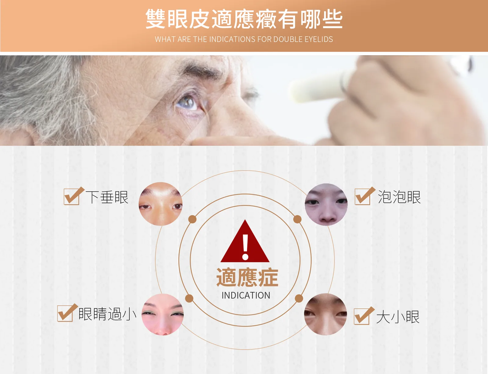 割雙眼皮