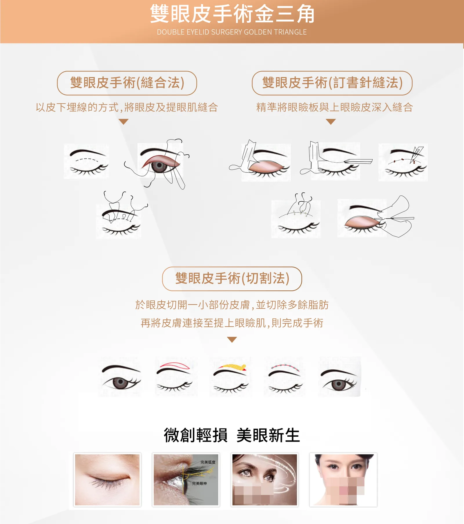割雙眼皮 介紹 2